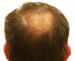 Causes of sudden hair loss