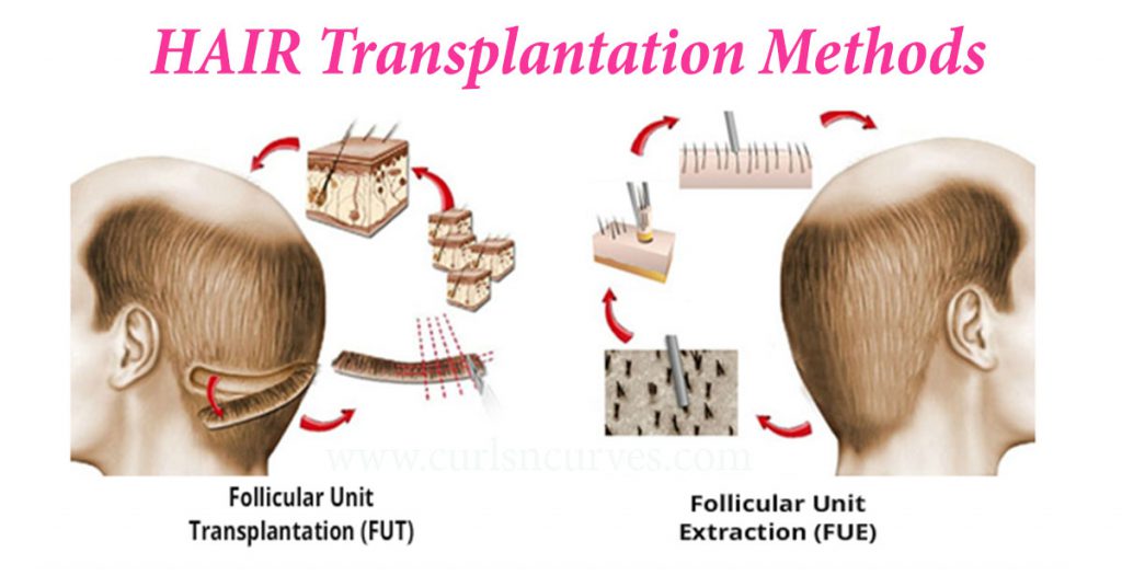 Hair transplant methods: FUT vs FUE