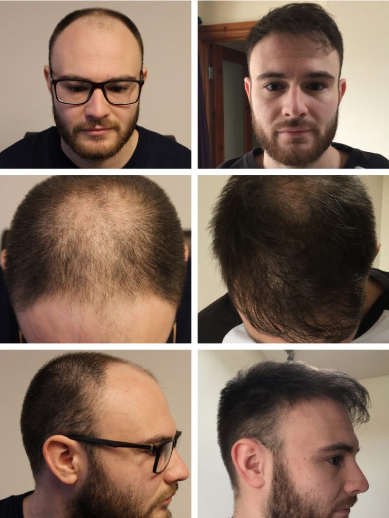 Hair transplant before after images