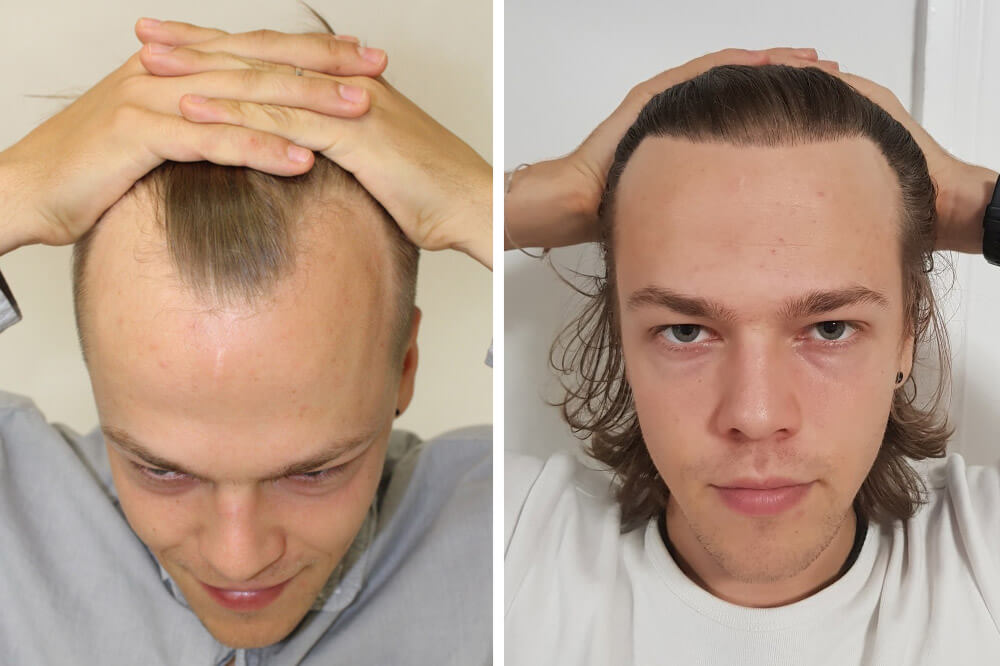 receding hairline treatment - mature hairline at a young age