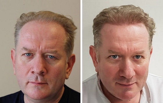 General hair transplant to improve look - volume, density increase