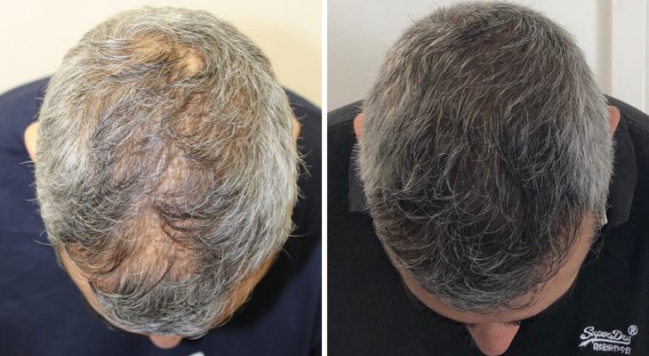 Thicker hair transplant to improve thinning hair