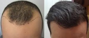 Hair transplant Bristol